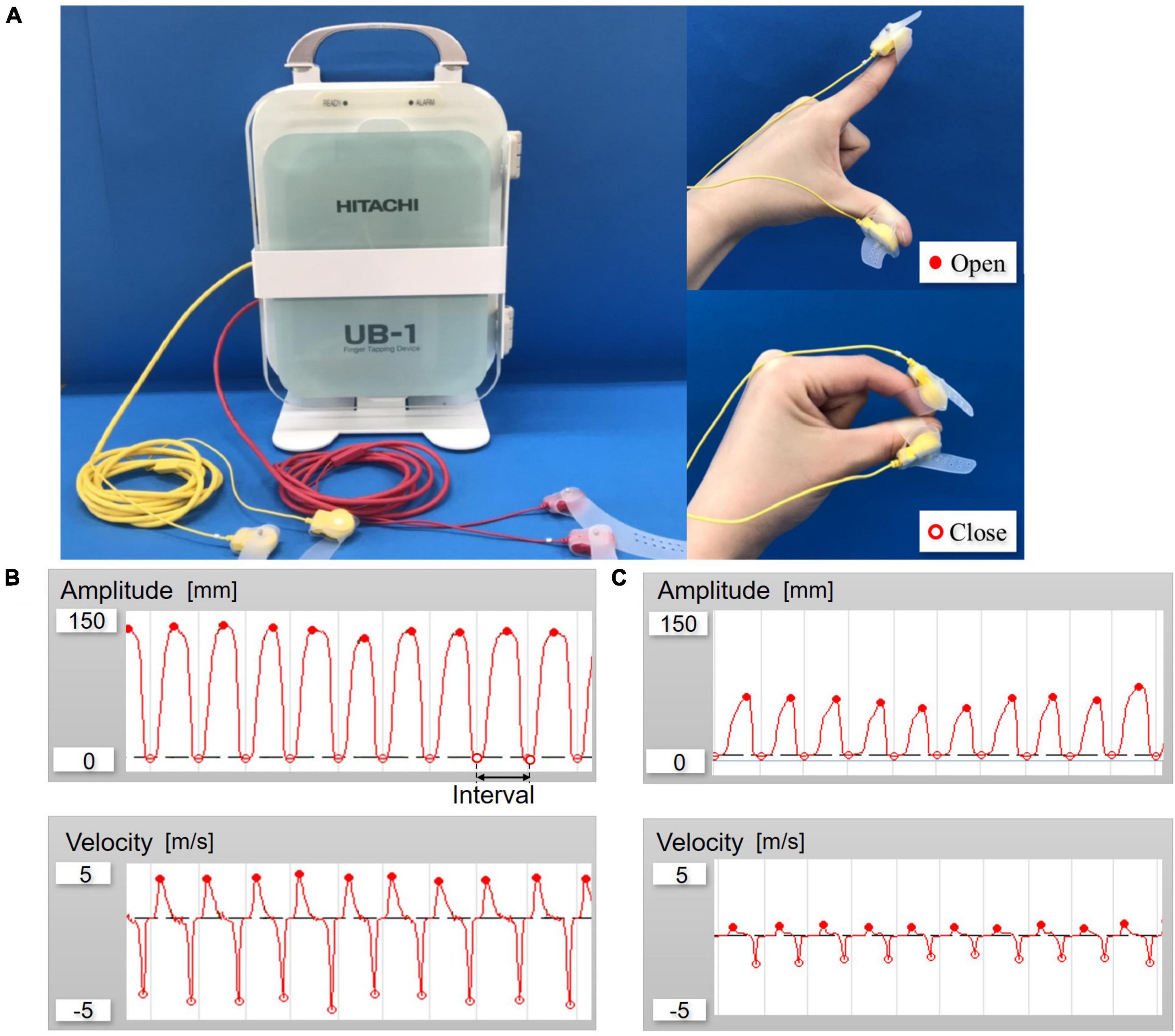 Clinical utility of paced finger tapping assessment in idiopathic normal pressure hydrocephalus